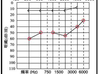 哪些因素影响纯音测试